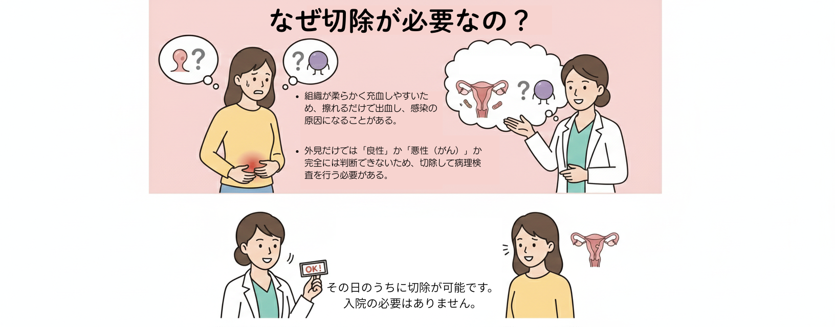 子宮頸ポリープ切除の必要性-東京-The_need_for_cervical_polyp_surgery